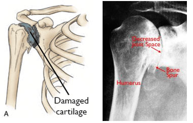 Osteoarthritis of the shoulder.