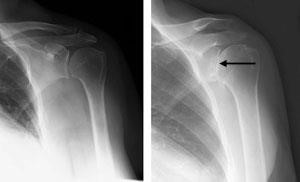 An X-ray of a healthy shoulder joint.