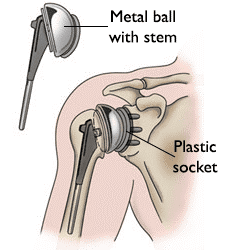 Anatomical total shoulder joint replacement.