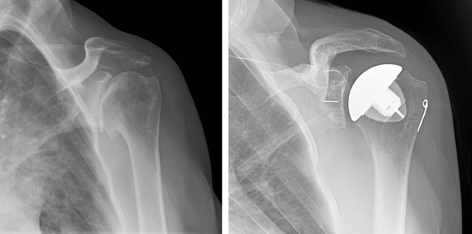 X-rays after anatomical total shoulder replacement surgery for osteoarthritis.