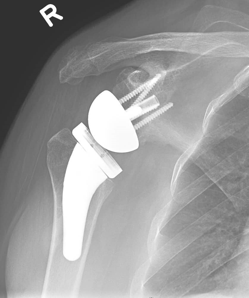 X-ray of a reverse total shoulder replacement.