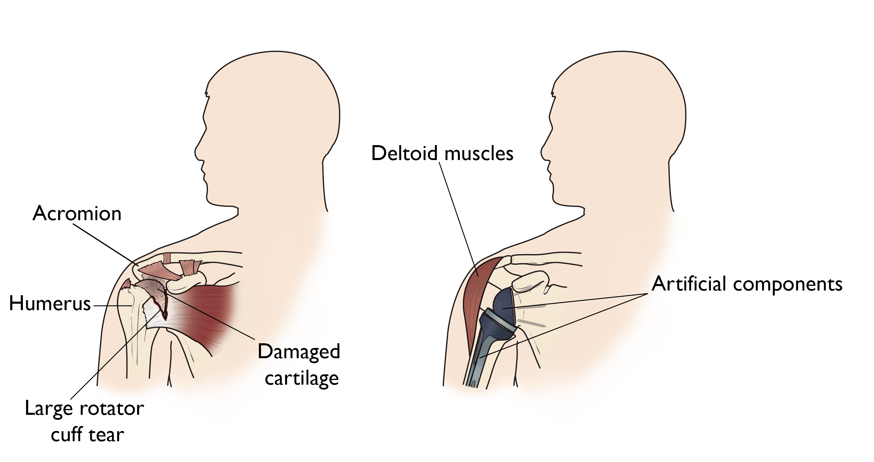 Rotator cuff arthropathy