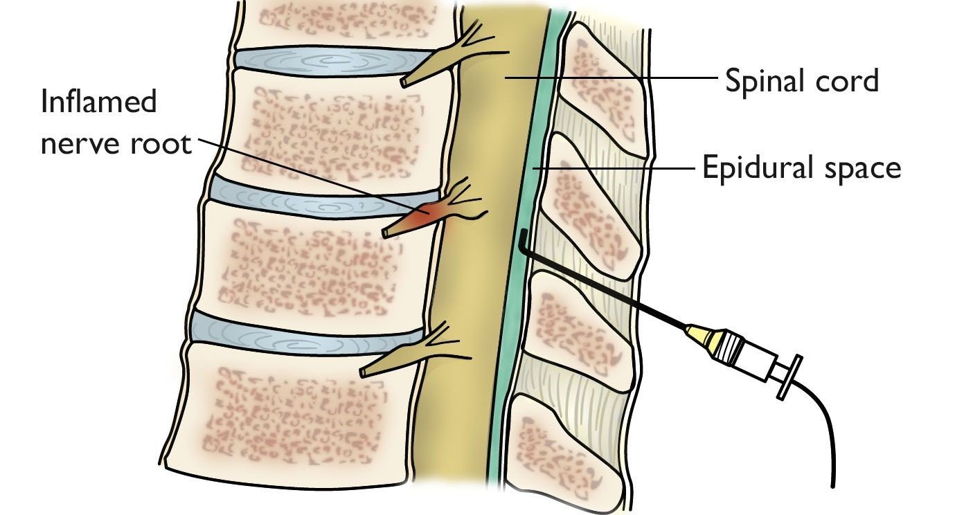 Epidural Injections