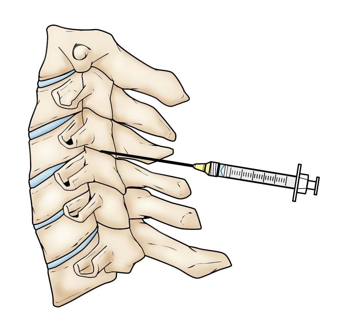 Facet joint injection in the lumbar spine (low back).