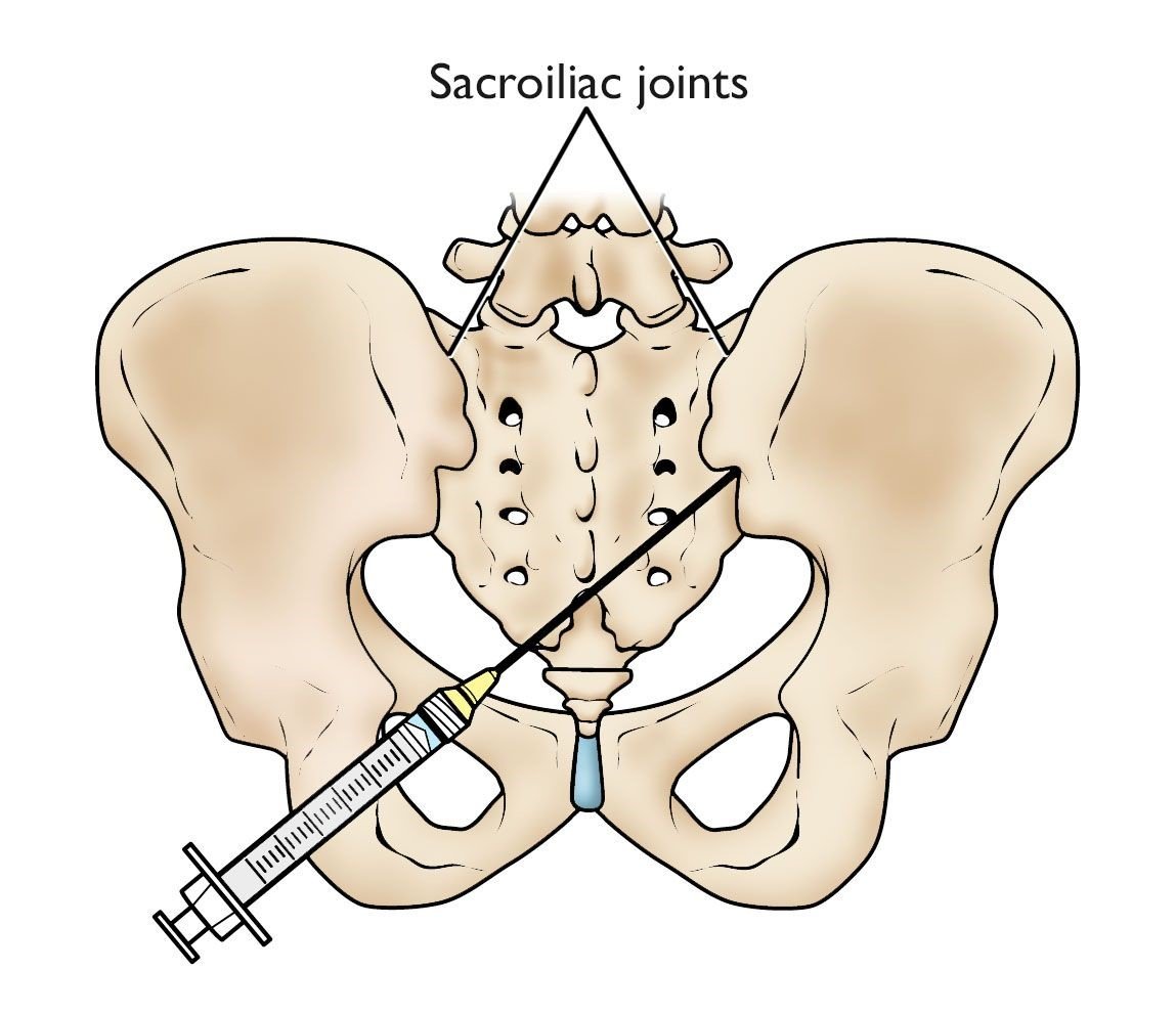 Sacroiliac Joint Injections