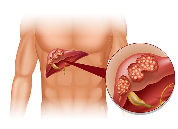 Liver Tumours