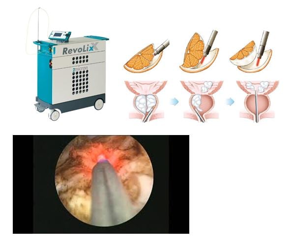 Holmium Laser Enucleation of the Prostate Procedure in Chennai Dr