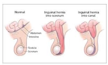 Swelling or Pain in Scrotum - Rela Hospital