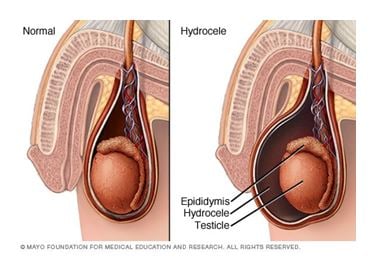 What Causes Groin Swelling In Young Children And What To Do About It In  Malaysia