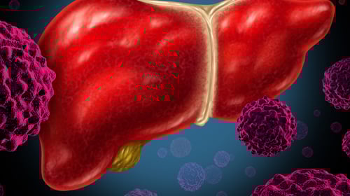 Liver Cancer: What You Should Know Liver Cancer: What You Should Know
