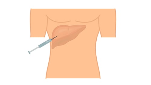Liver Biopsy: Everything You Need to Know Liver Biopsy: Everything You Need to Know