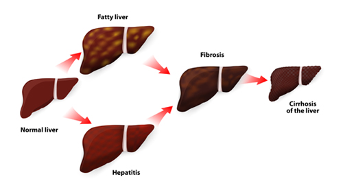 Liver Cirrhosis: Alcoholic Health Complication