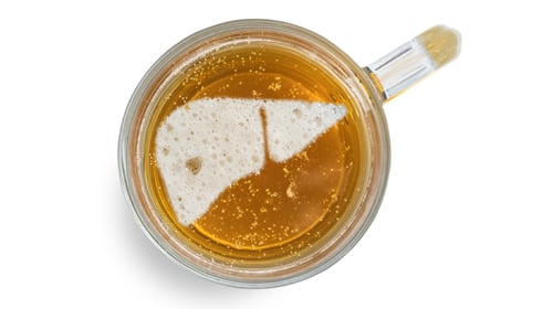 Alcoholic Liver Disease: Symptoms, Causes & Diagnosis Alcoholic Liver Disease: Symptoms, Causes & Diagnosis