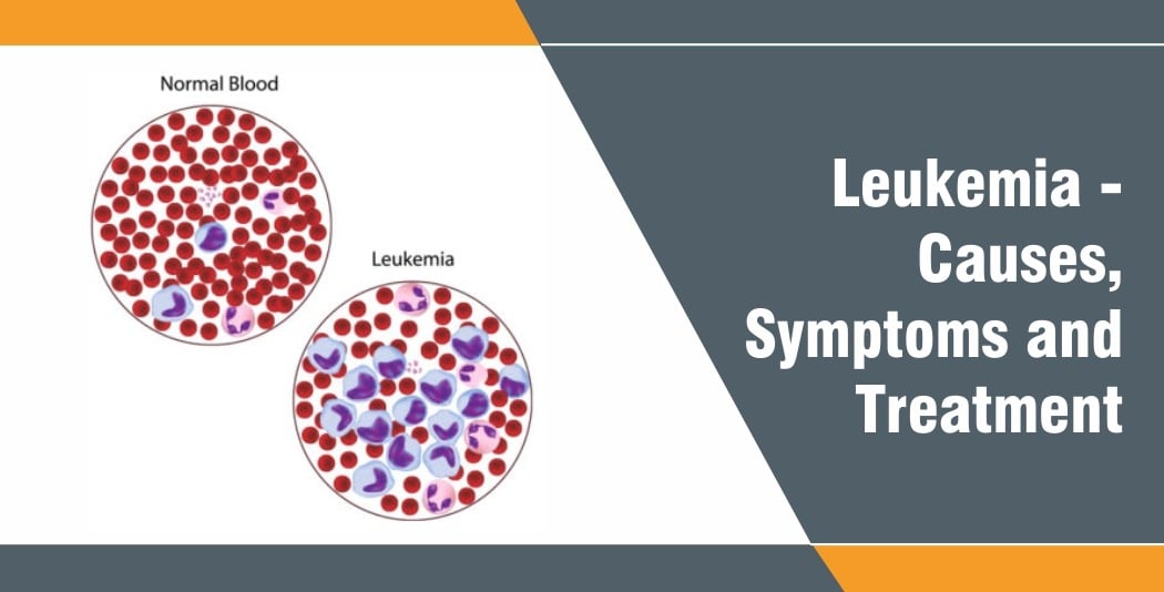 Blood Cancer – Causes, Symptoms and Treatment Blood Cancer – Causes, Symptoms and Treatment