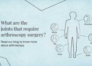 What is Arthroscopy Surgery: Procedure, Conditions, and Recovery