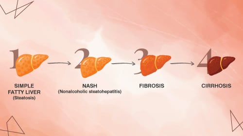 Fatty Liver Disease : Diet & Lifestyle Guidance Fatty Liver Disease : Diet & Lifestyle Guidance