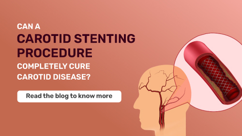 Carotid Artery Stenting