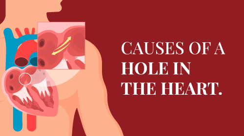 Hole in the Heart – Symptoms, Causes & Treatment