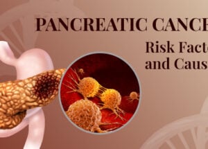 Pancreatic Cancer: Symptoms, Causes and Treatment
