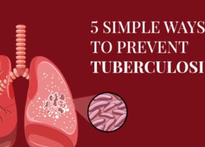 مرض السل (TB): الأعراض، الأنواع، التشخيص، والعلاج