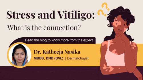 Stress and Vitiligo Stress and Vitiligo