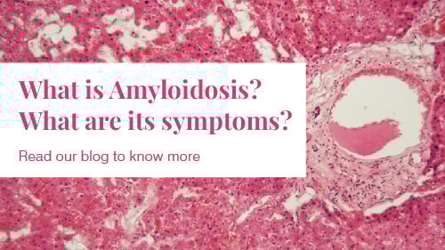 Amyloidosis: Causes and Treatment Amyloidosis: Causes and Treatment