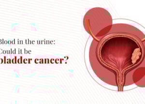 What is Bladder Cancer? Types, Symptoms, and Treatment