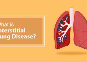 مرض الرئة الخلالي (ILD): الأعراض والأسباب والأنواع وخيارات العلاج