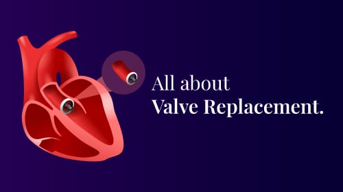 Valve Replacement Surgery: Types, Procedures, and Recovery