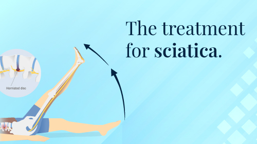 How to Cure Sciatica Permanently
