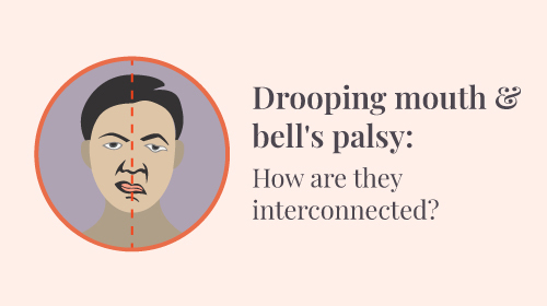 What is Bell’s palsy?