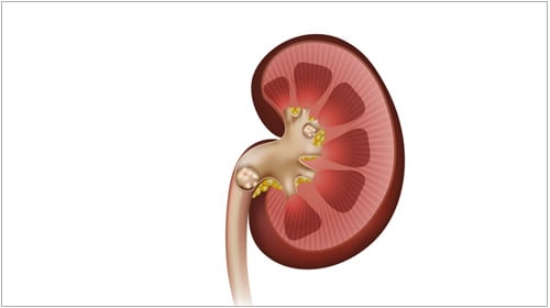 Urinary stones Urinary stones