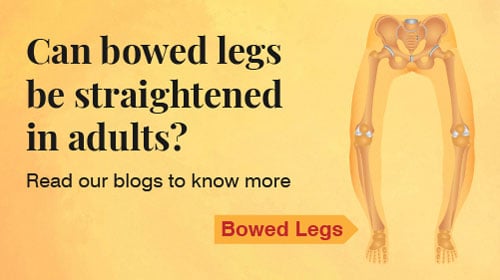 Bowed Legs & Knock Knees Bowed Legs & Knock Knees