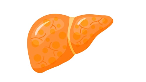 Non-alcoholic Fatty Liver Disease Non-alcoholic Fatty Liver Disease