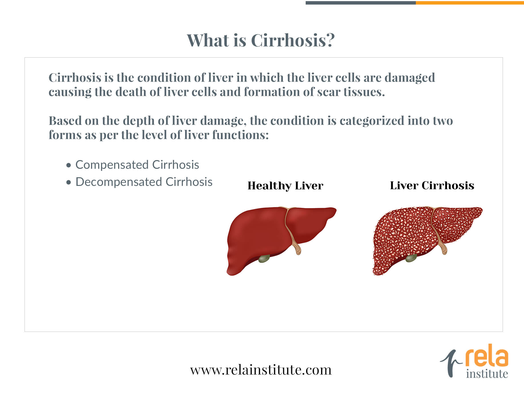 Decompensated Cirrhosis