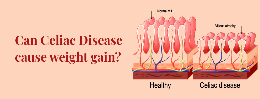 What is celiac disease: Symptoms, Causes, and Treatment
