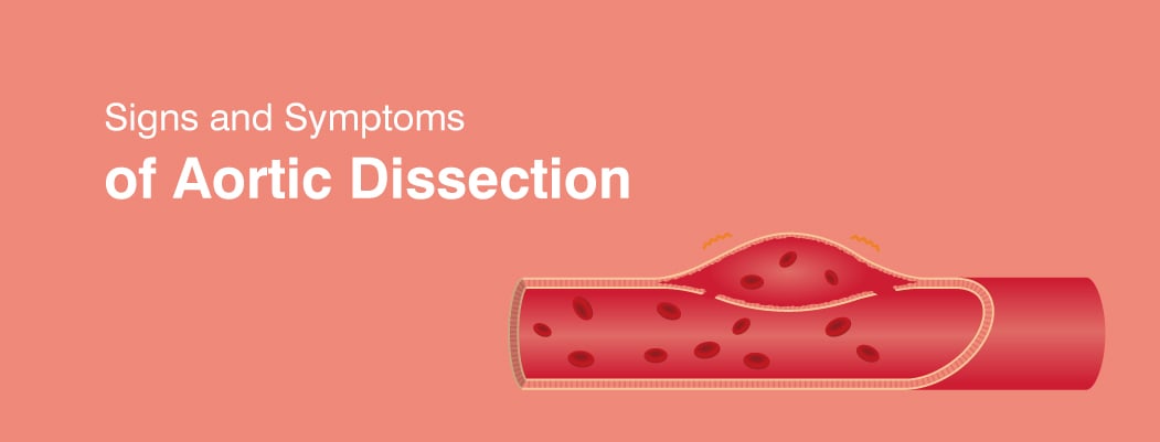 Aortic Dissection: Causes, Symptoms & Treatments Aortic Dissection: Causes, Symptoms & Treatments