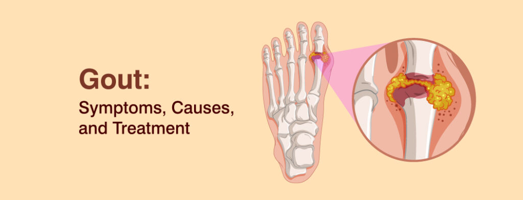 What is gout disease: Symptoms and Treatment