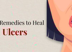 Mouth Ulcers: Causes, Symptoms and Treatments