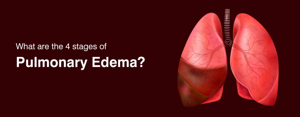 Pulmonary Edema: Symptoms and Treatments Pulmonary Edema: Symptoms and Treatments