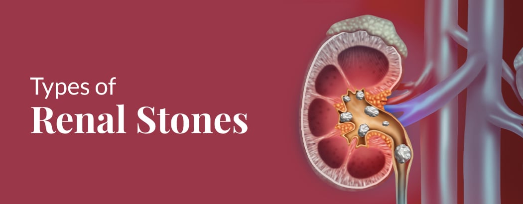 Types of Kidney Stones
