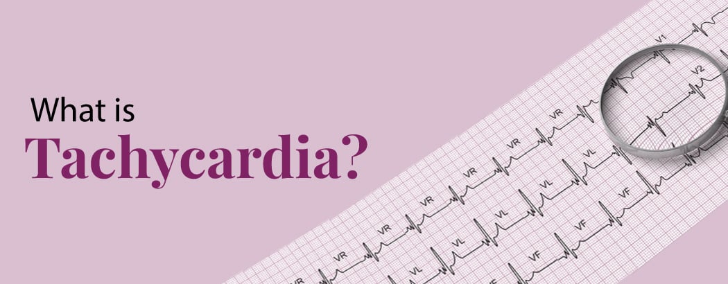 Tachycardia (High Heart Rate): Causes, Symptoms, and Treatment Tachycardia (High Heart Rate): Causes, Symptoms, and Treatment