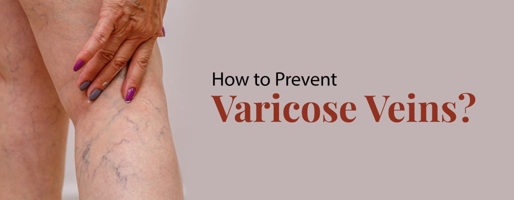 Varicose Veins: Causes, Symptoms, Treatment, and Prevention Varicose Veins: Causes, Symptoms, Treatment, and Prevention