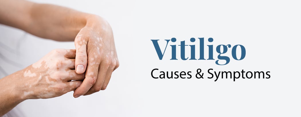Vitiligo – Causes, and Symptoms
