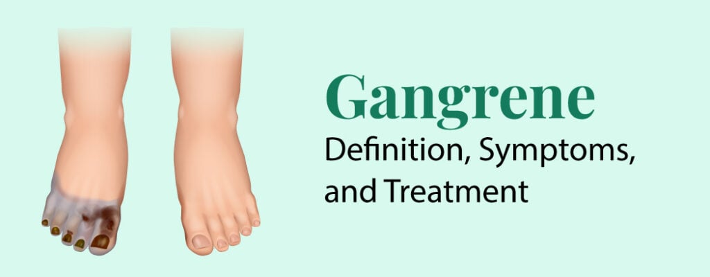 Gangrene - Definition, Symptoms, and Treatment