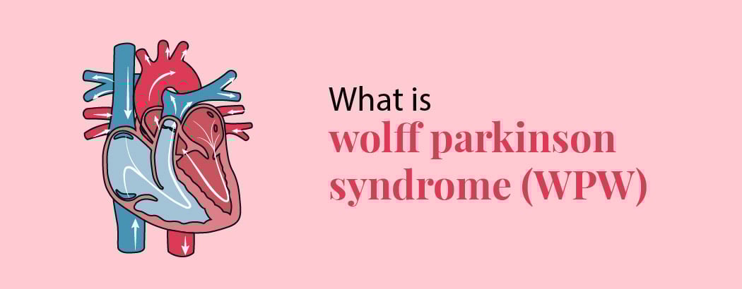 Wolff-Parkinson-White Syndrome (WPW): Symptoms, Causes, and Treatment Wolff-Parkinson-White Syndrome (WPW): Symptoms, Causes, and Treatment