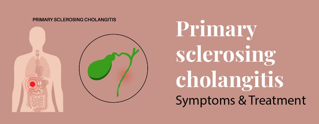 Primary Sclerosing Cholangitis – Symptoms and Treatment Primary Sclerosing Cholangitis – Symptoms and Treatment