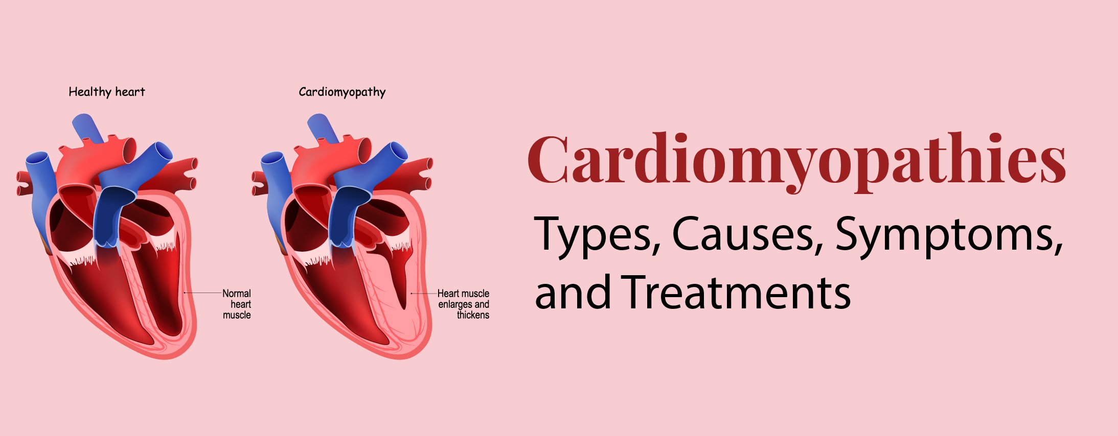 Cardiomyopathies: Types, Causes, Symptoms, and Treatments Cardiomyopathies: Types, Causes, Symptoms, and Treatments