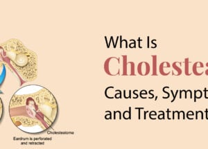 What is Cholesteatoma: Cause, Symptoms and Treatment