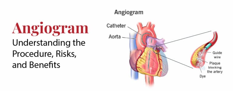 Simple Angiogram Angiogram: Understanding the Procedure, Risks, and Benefits